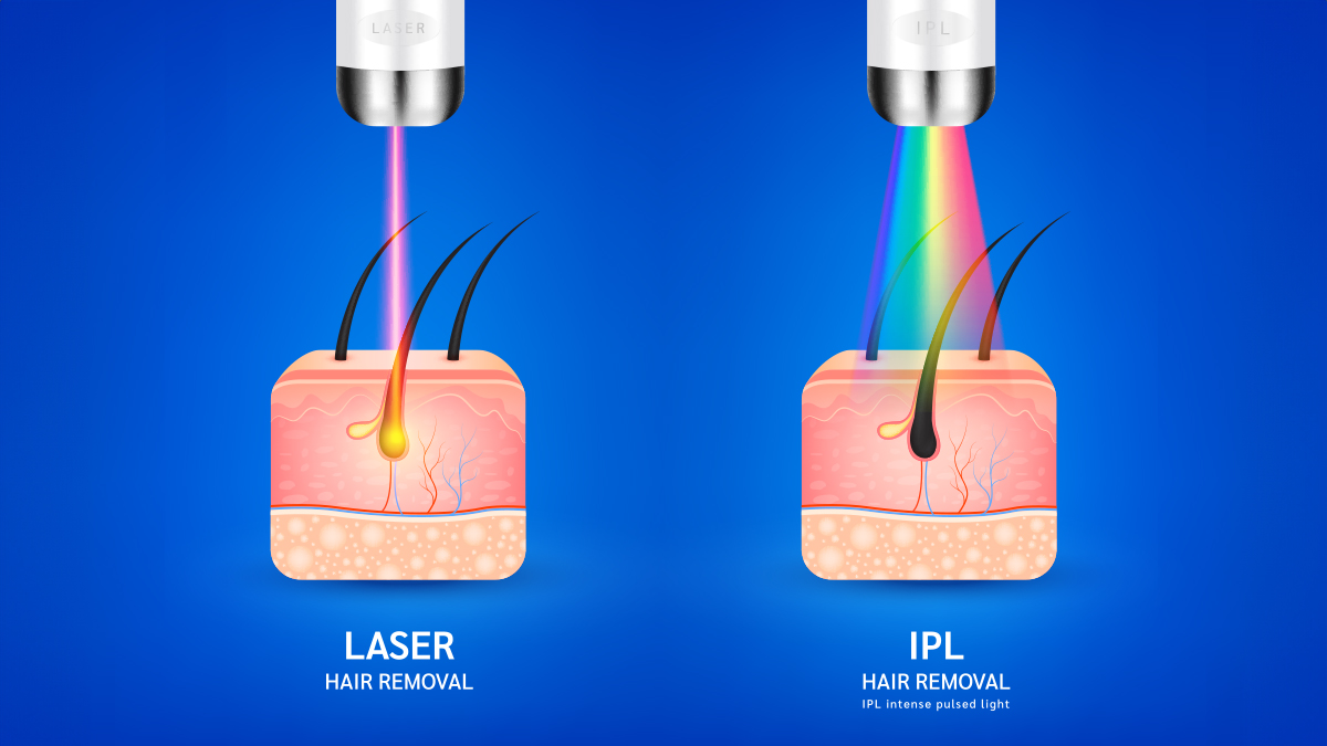 A vector image showing how laser treatment targets hair follicle with monochrome source of light on the left, and how IPL treats hair follicle with broadband spectrum of light